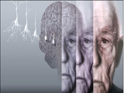 آلزایمر (Alzheimer)