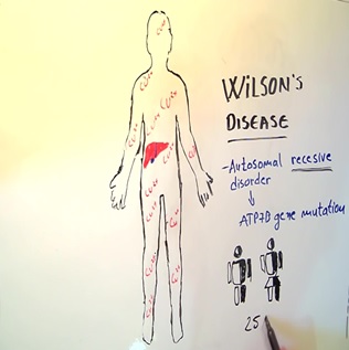 بیماری ویلسون (WD)