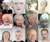 آلبینیسم چشمی پوستی (OCA: Oculocutaneous albinism) 