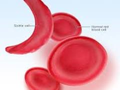 بیماری آنمی داسی شکل(Sickle cell anemia)