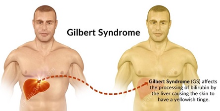 سندرم ژیلبرت (Gilbert's syndrome)
