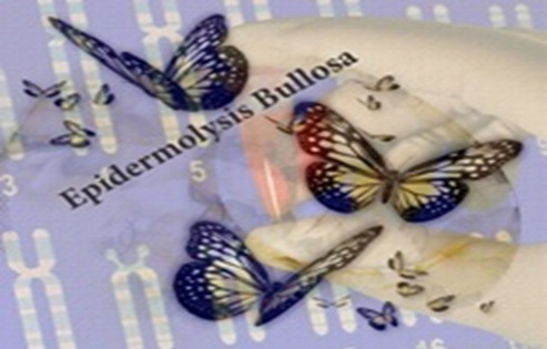 بیماری پروانه‌ای یا اپیدرمولیزیس بولوسا (Epidermolysis bullosa) (ایی‌.بی: E.B) 