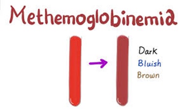 بیماری مت هموگولوبینمیا Methemoglobinemia (MetHb) 