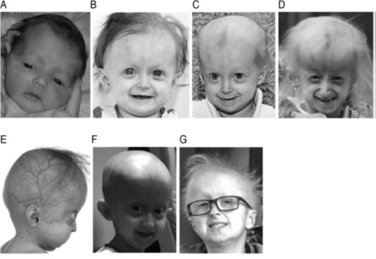 آزمایشگاه اریترون- پیری زودرس کودکی (progeria)