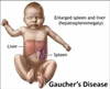 بیماری گوشه (Gaucher's disease)